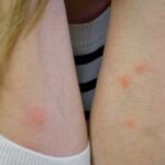 A person with visible red bites on their arms, suggesting possible insect bites from termites.