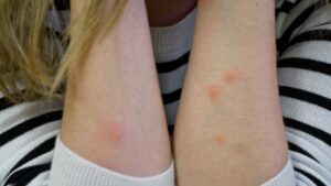 A person with visible red bites on their arms, suggesting possible insect bites from termites.